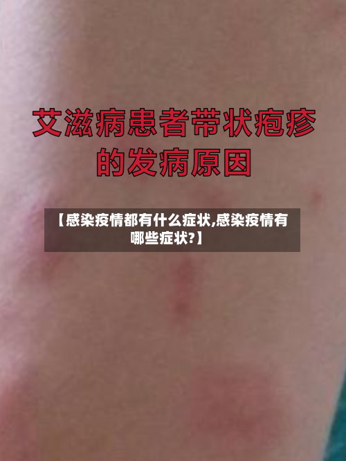 【感染疫情都有什么症状,感染疫情有哪些症状?】-第1张图片